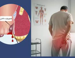 درمان هموروئید بدون جراحی