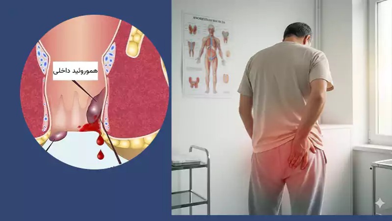 درمان هموروئید بدون جراحی؛ راهکاری علمی برای کاهش درد و التهاب